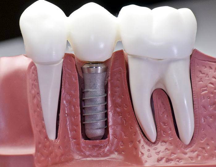 implant clinique dentaire tunisie